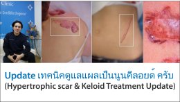 Update เทคนิคดูแลแผลเป็นนูนคีลอยด์ ครับ (Hypertrophic scar & Keloid Treatment Update)